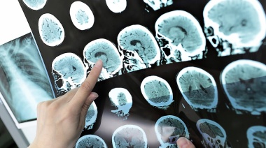 Nuevas pistas para la identificación temprana de Alzheimer