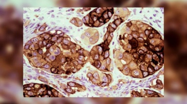 Una vacuna argentina contra el cáncer de piel demostró una alta eficacia para los casos más graves
